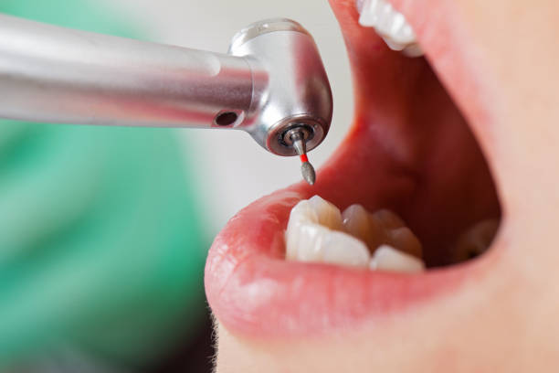 Best Emergency Tooth Extraction in Callahan, FL